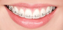 Self-Ligating Braces Self-Ligating Braces