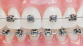 Damon Braces Damon Braces