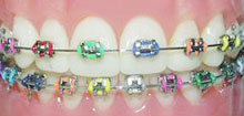 Metal Braces Metal Braces