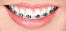 Metal Braces Metal Braces