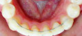 Fixed Retainers Fixed Retainers