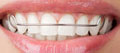 Hawley Retainer Hawley Retainer