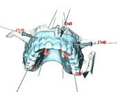 Conventional Dental Implants Conventional Dental Implants