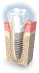 One Day and Immediate Dental Implants, Bangkok One Day and Immediate Dental Implants, Bangkok