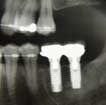 Bangkok Implants, Dental X-ray Bangkok Implants, Dental X-ray