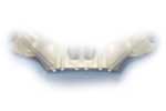 Bangkok Dental Implant, Fixed Bridges on Implants Bangkok Dental Implant, Fixed Bridges on Implants