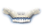 Bangkok Dental Implant, Fixed Bridges on Implants Bangkok Dental Implant, Fixed Bridges on Implants